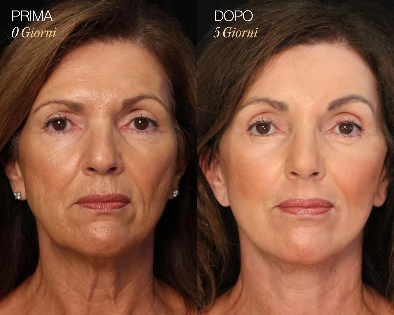 Lymphatic Face Brush iBrushy